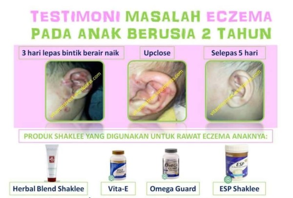 Testimoni Shaklee: Rawatan Eczema